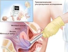 Urīnpūšļa ultraskaņa: indikācijas, sagatavošana un procedūras tehnika